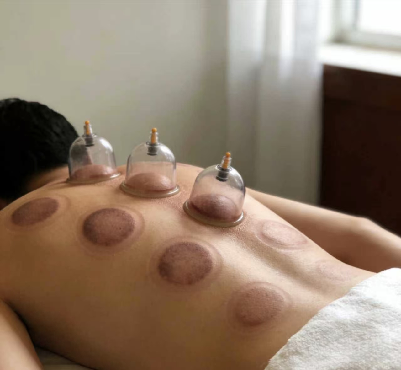 Cupping Therapy
